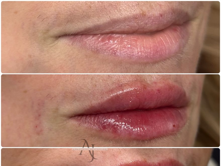 Lip filler before, straight after and healed, AbbieJaine Aesthetics Basildon