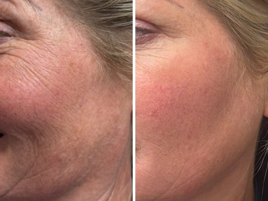 Skin booster result on the cheeks, before and after, AbbieJaine Aesthetics Basildon